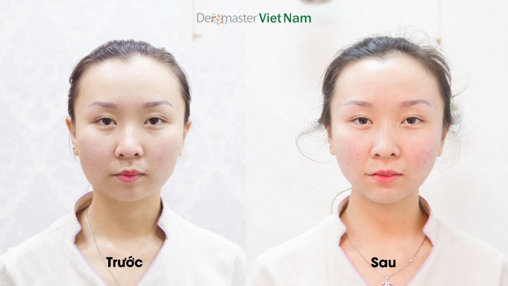 Kết quả giảm béo mặt với meso Face V-line Plus (nguồn hình Dermaster Việt Nam)