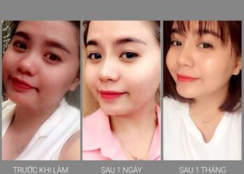 Review phương pháp nâng mũi bằng chỉ Ultra V Lift