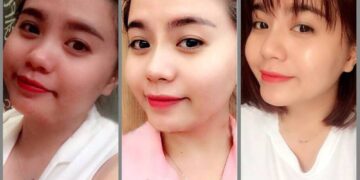 Review phương pháp nâng mũi bằng chỉ Ultra V Lift